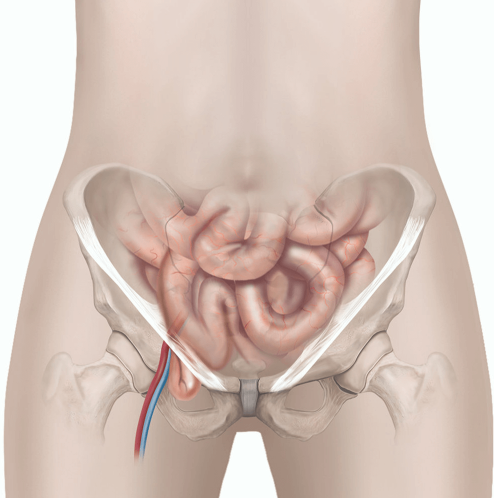 Femoral hernia consultation